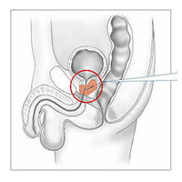 淺談攝護腺肥大之核保風險 (Benign Prostatic Hyperplasia,簡稱BPH) 淺談攝護腺肥大之核保風險 (Benign Prostatic Hyperplasia,簡稱BPH)